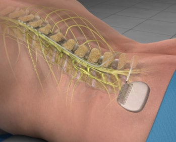 Spinal Cord Stimulation