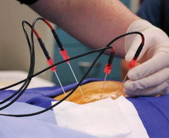 Radiofrequency Ablation Near Webster, TX