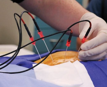 Radiofrequency Ablation Near Santa Fe, TX