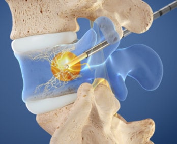 Intracept Procedure Near Santa Fe, TX